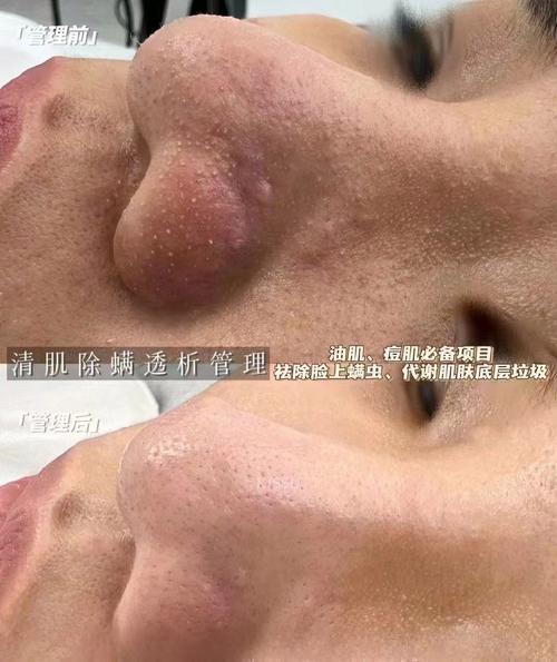 脸上为什么长螨虫