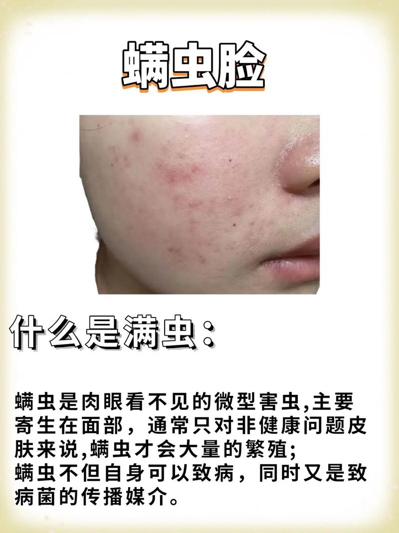 脸上为什么长螨虫