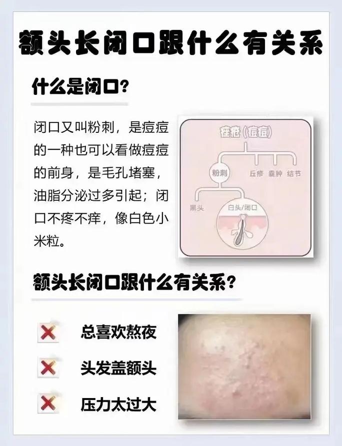 脸上为什么会长闭口