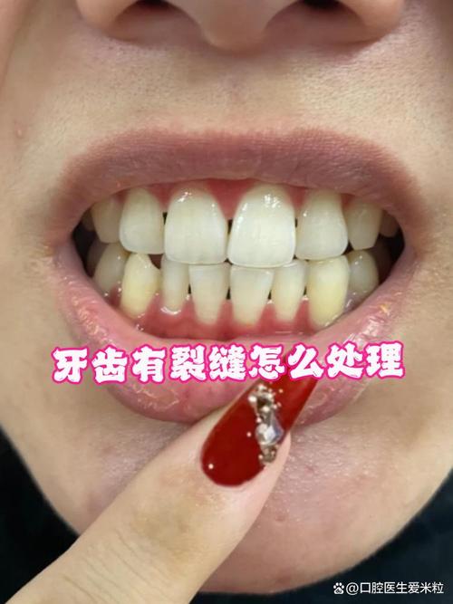 牙为什么裂