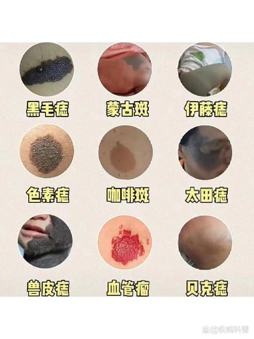 什么是胎痣