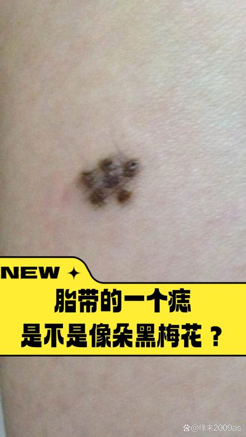 什么是胎痣