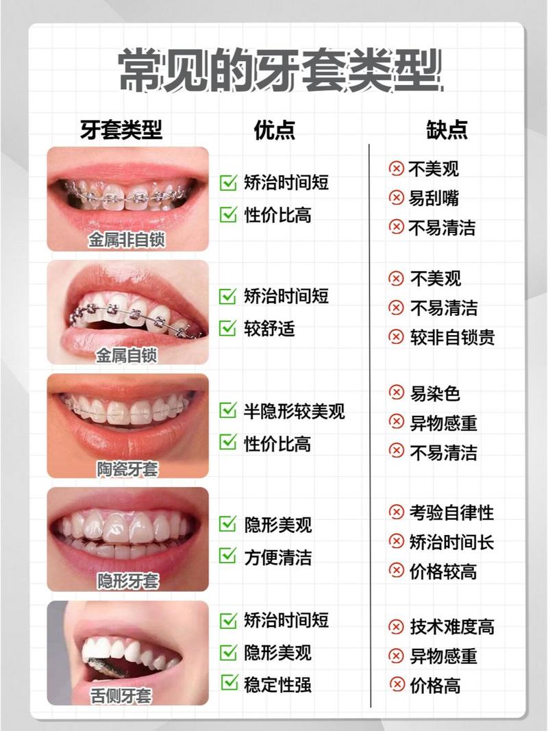 什么牙套比较好