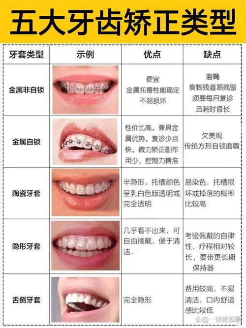 什么牙套比较好
