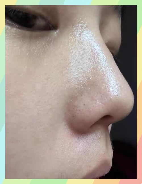 用洗面奶怎么长黑头了