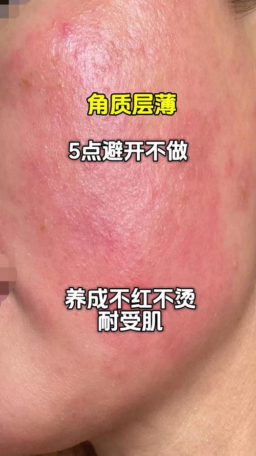 什么是角质层薄