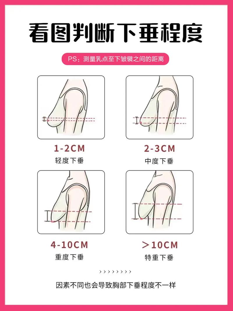 乳房下垂是什么原因