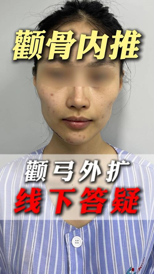 为什么会颧骨外扩