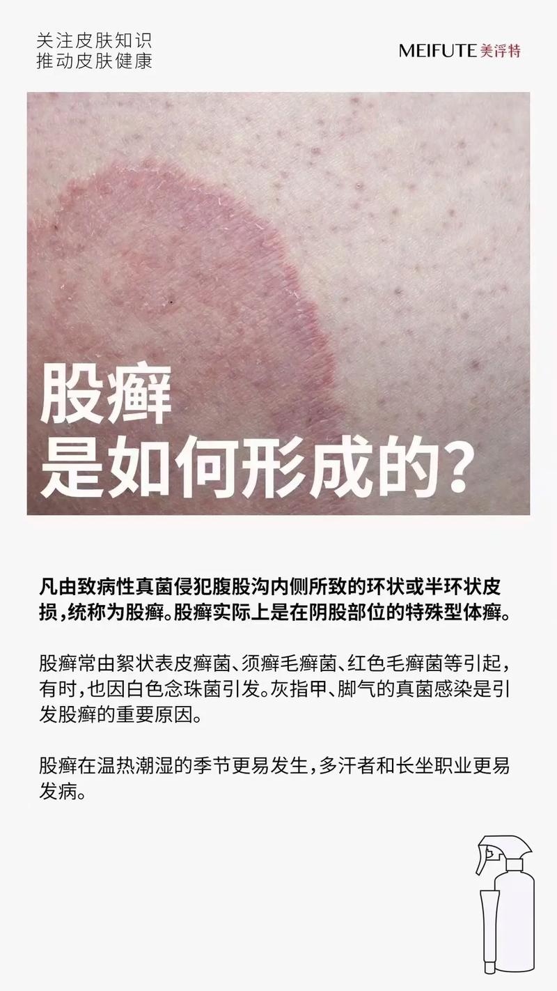 股癣是什么意思