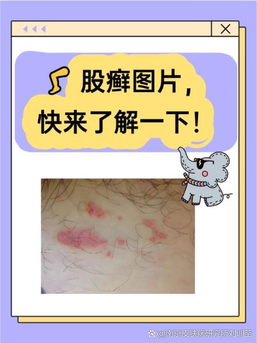 股癣是什么意思