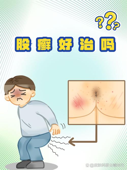 股癣是什么意思