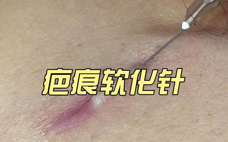 什么是疤痕针