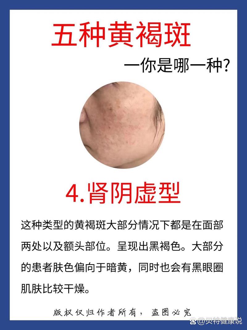 什么是褐斑