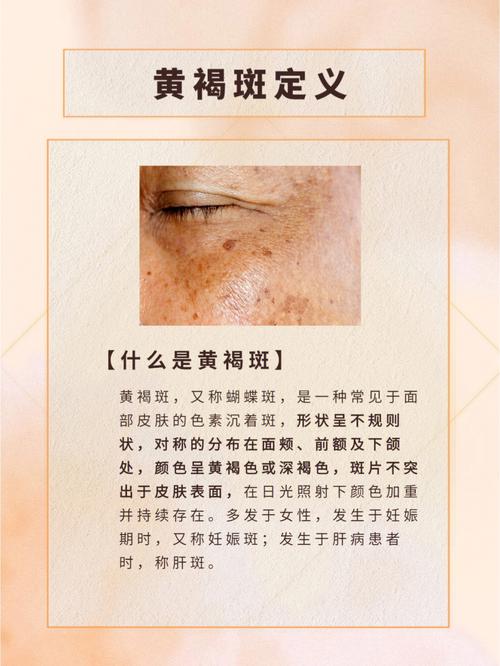 什么是褐斑