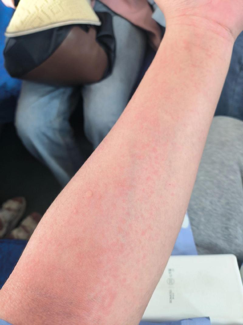 过敏性皮炎什么症状