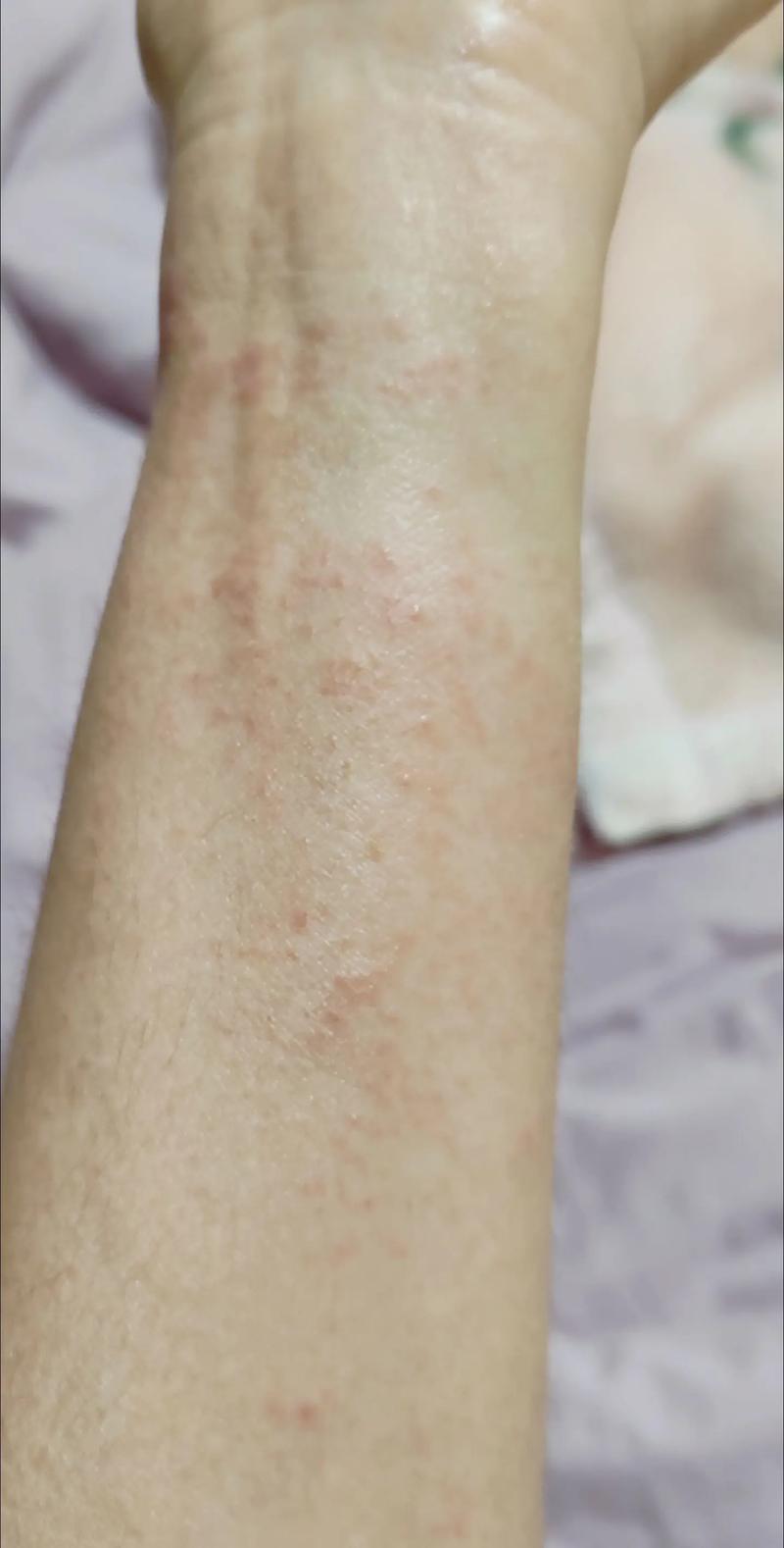 过敏性皮炎什么症状