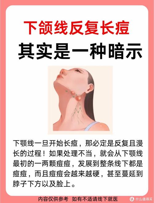 下颌长痘是什么原因