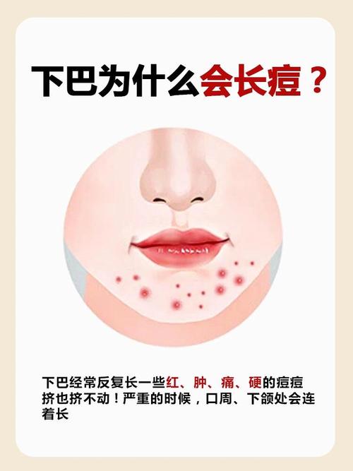下颌长痘是什么原因