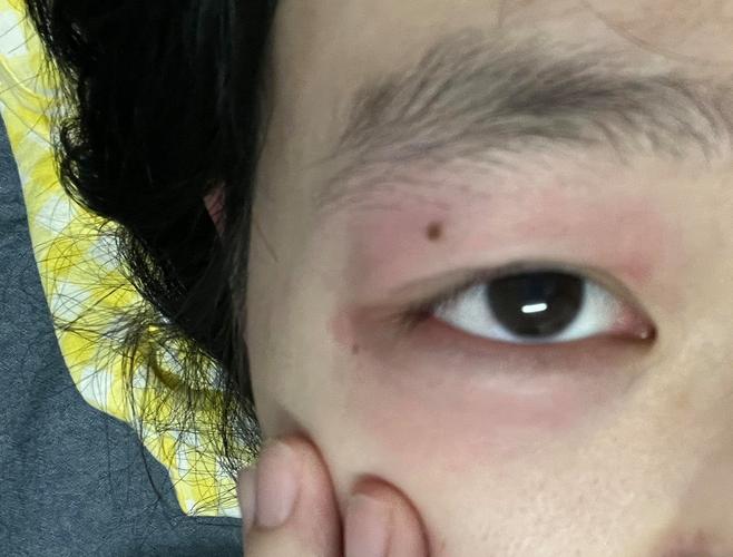 哭完眼睛为什么会肿