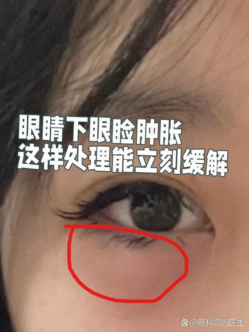 哭完眼睛为什么会肿