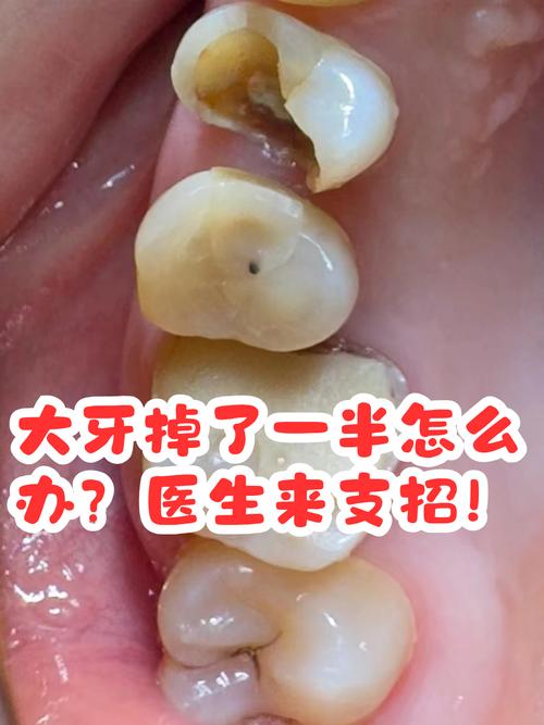 牙齿为什么会掉一块