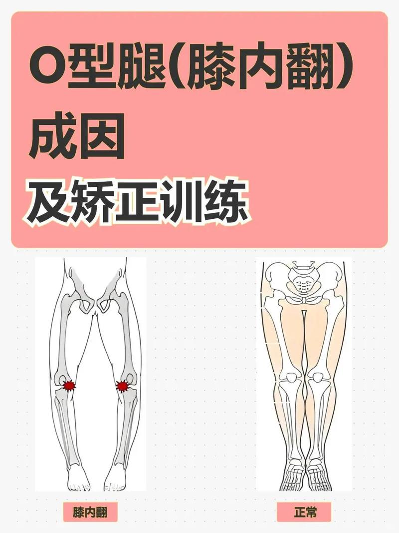 为什么会有o型腿