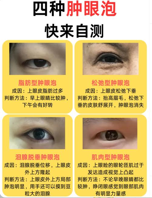 肿眼泡什么意思
