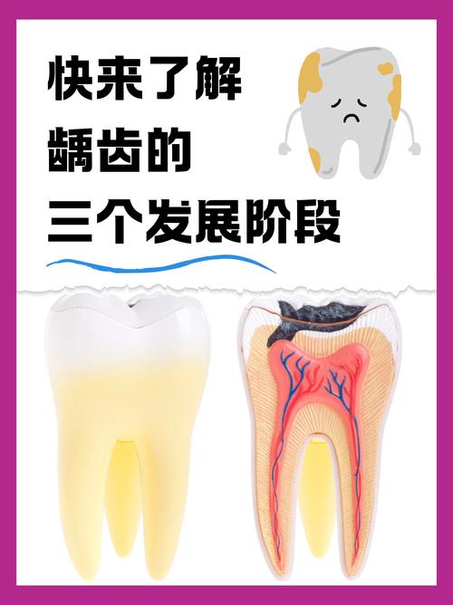 什么是龋牙