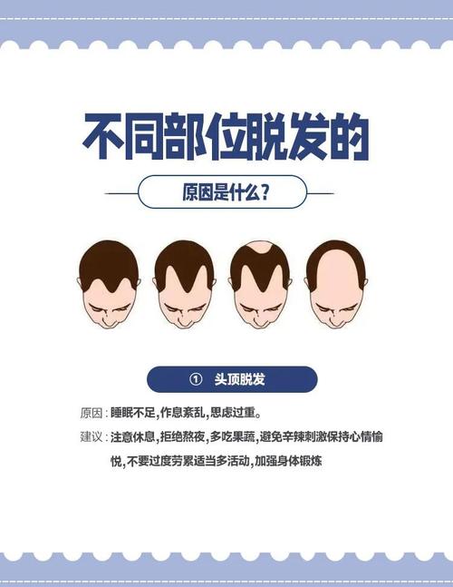 头顶掉发是什么原因