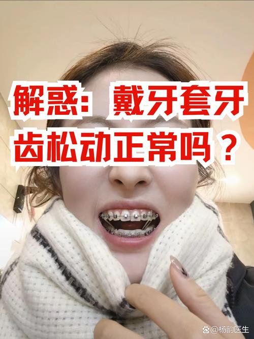 戴牙套是什么原理