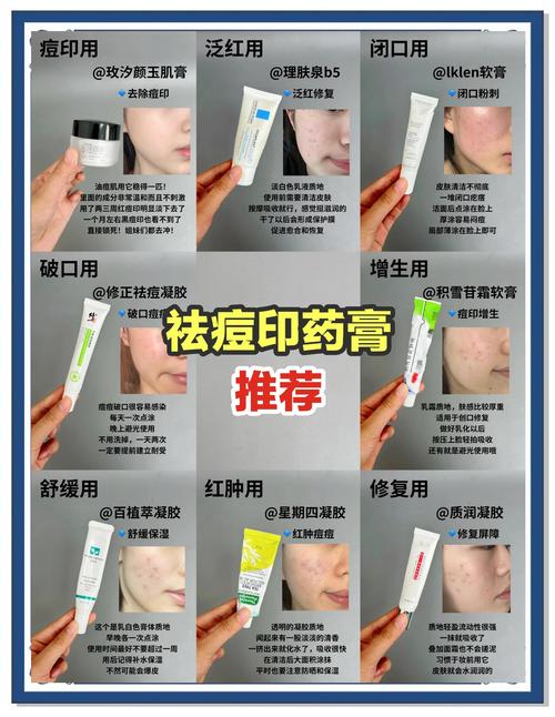 脸上长痘抹什么药膏