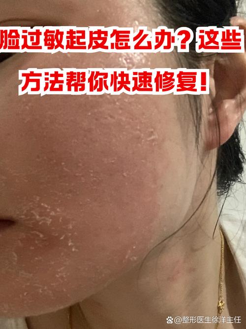 洗面奶过敏皮肤脱皮怎么办
