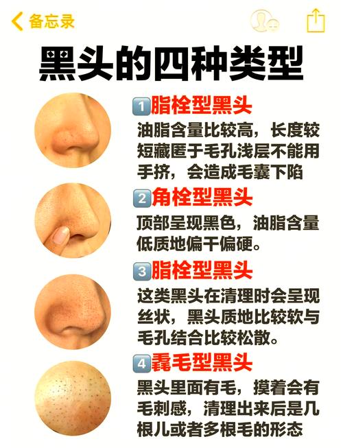 为什么会出现黑头