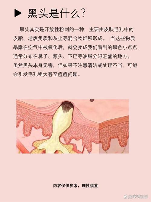 为什么会出现黑头