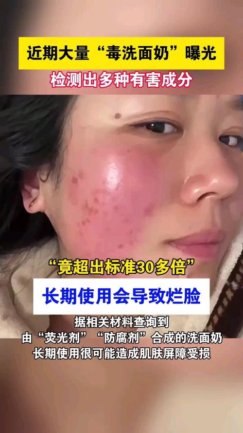 用完洗面奶脸过敏了怎么办