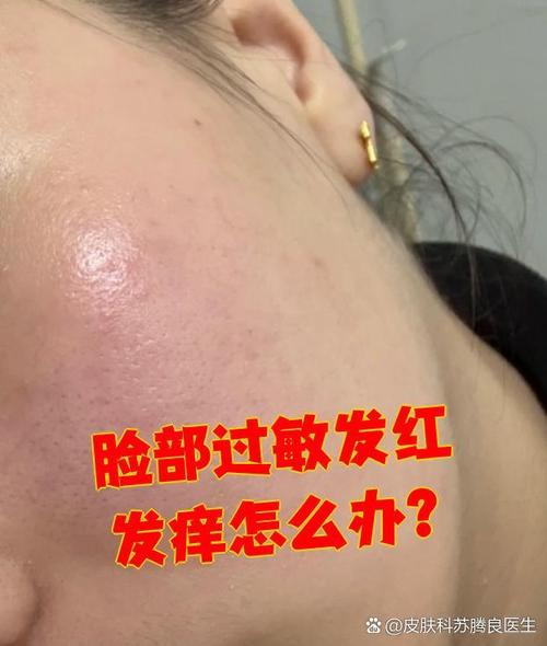 用完洗面奶脸过敏了怎么办
