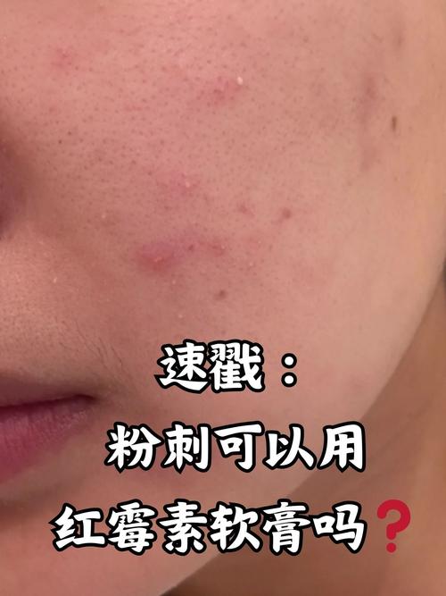 脸上为什么有粉刺