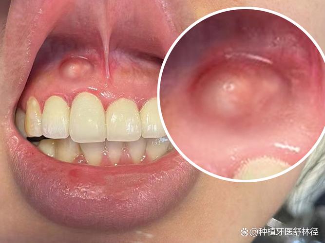 牙龈上火什么症状