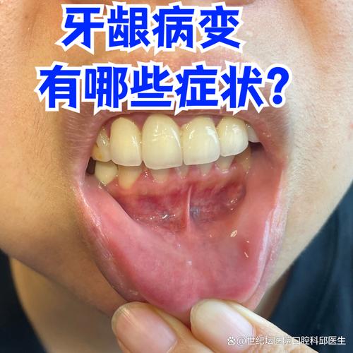牙龈上火什么症状