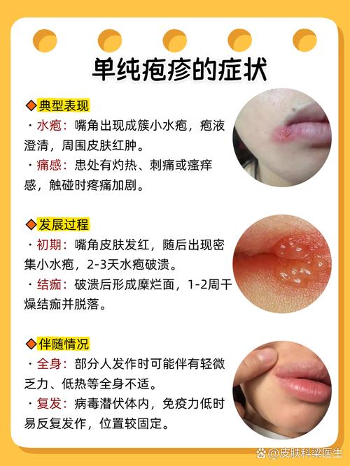 什么治疱疹