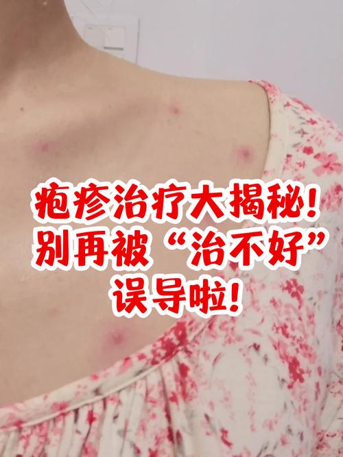 什么治疱疹