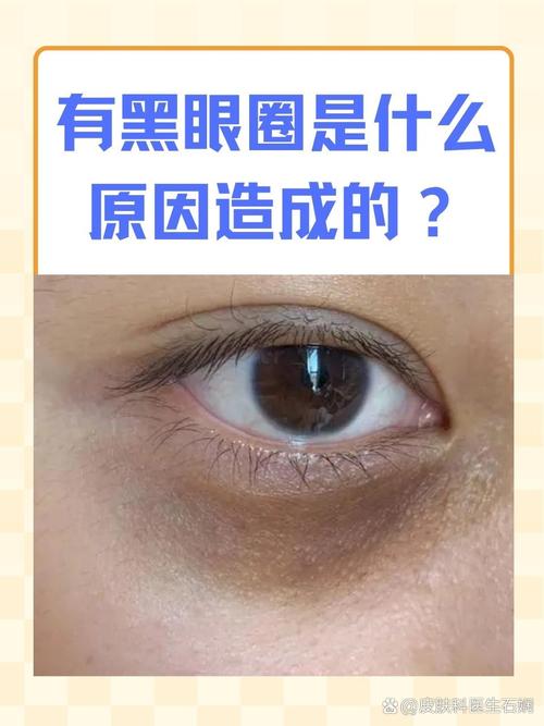 为什么会出现黑眼圈