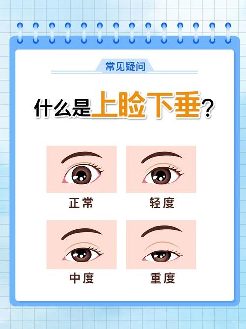 什么是上睑下垂