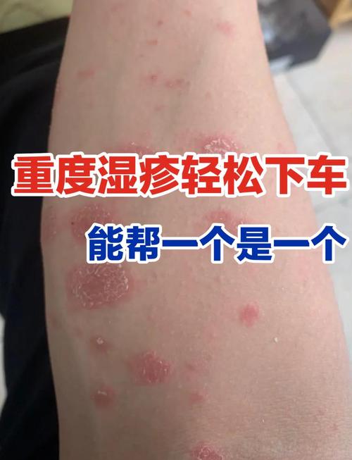 什么治疗湿疹效果好