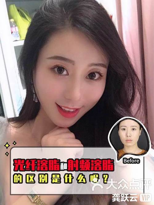 光纤溶脂是什么