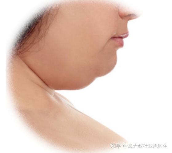 什么叫双下巴