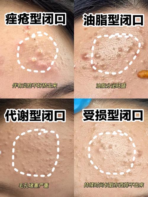 什么是毛孔堵塞