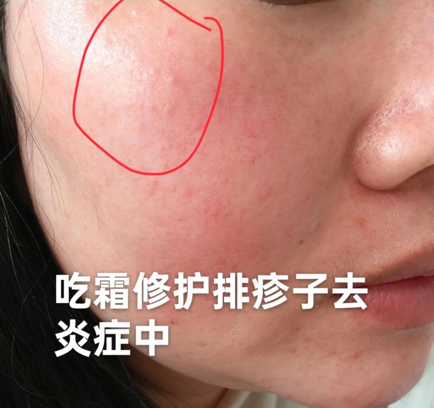 减肥霜对皮肤有什么伤害