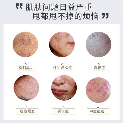 老中医痘清洗面奶怎么用