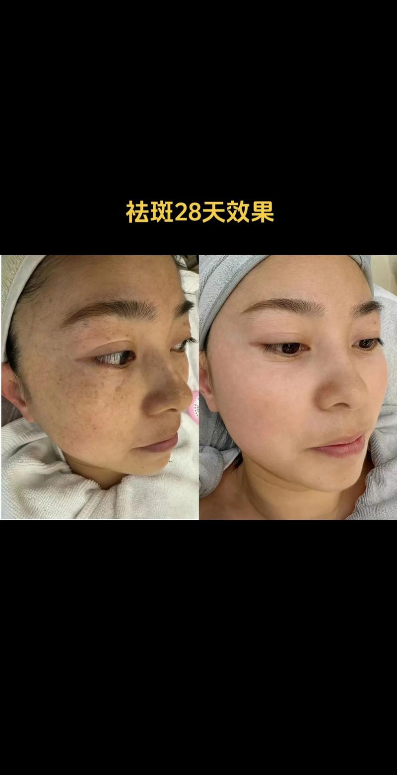 什么是祛斑的